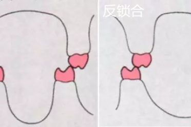 后牙“锁合”：当牙齿齿轮错位卡住时