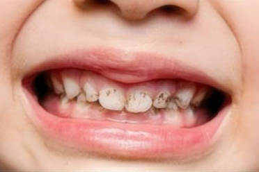 宝宝牙齿变黑不是“蛀牙”？一文读懂儿童牙齿黑色素沉着