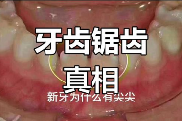 孩子新长出的门牙像锯齿样是正常的吗？