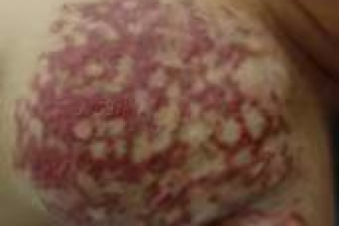 口腔里的“红宝石”“蓝宝石”:揭开口腔血管瘤的神秘面纱