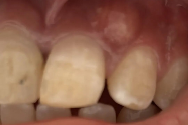 牙龈起包，上火了？