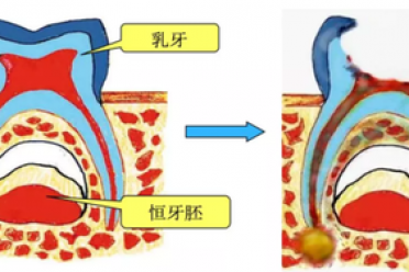乳牙:家长可能忽视的养护密码