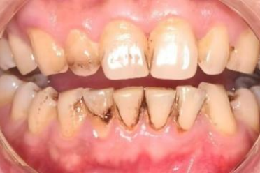 我的牙为什么老是刷不白？