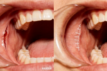 关于孩子受伤缝针，家长最关心的几个问题